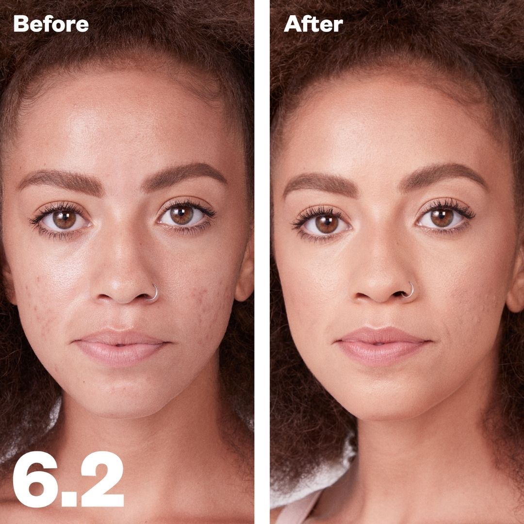 Kosas Revealer Concealer - Tone 6.2 Medium with neutral peach undertones. Before and after on models skin. Covers active breakouts, acne scarring, and hyperpigmentation. - AILLEA
